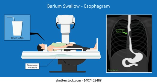 Barium Swallow Study Test Diagnose Barrett's GI Tract Exam GERD Ulcers Series Difficulty Pharynx Procedure UGI Throat Bowel Therapy