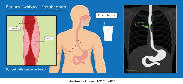 Barium Swallow Study Test Diagnose Barrett's GI Tract Exam GERD Ulcers Series Difficulty Pharynx Procedure UGI Throat Bowel Therapy