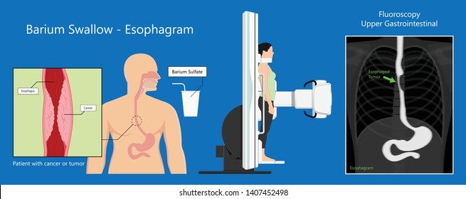 Barium Swallow Study Test Diagnose Barrett's GI Tract Exam GERD Ulcers Series Difficulty Pharynx Procedure UGI Throat Bowel Therapy