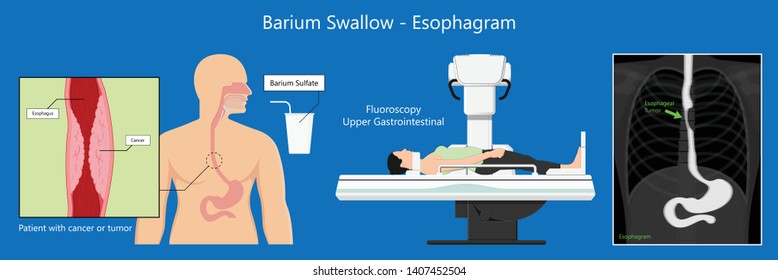 Barium Swallow Study Test Diagnose Barrett's GI Tract Exam GERD Ulcers Series Difficulty Pharynx Procedure UGI Throat Bowel Therapy