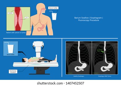 Barium Swallow Study Test Diagnose Barrett's GI Tract Exam GERD Ulcers Series Difficulty Pharynx Procedure UGI Throat Bowel Therapy