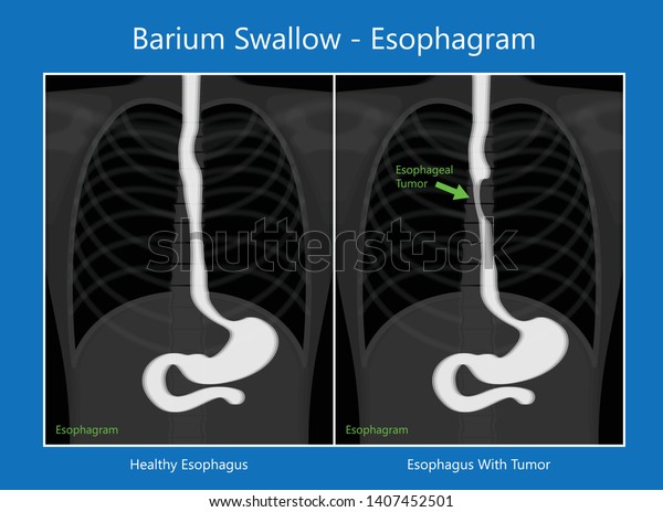 download barium swallow test
