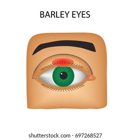 Barley eyes. Purulent inflammation. The structure of the eye. Infographics. Vector illustration on isolated background.