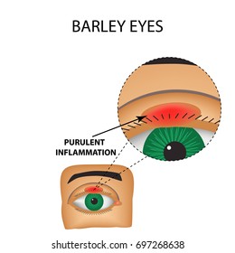 Barley eyes. Purulent inflammation. The structure of the eye. Infographics. Vector illustration on isolated background.