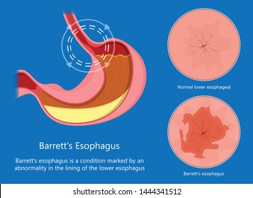 Barrett's Esophagus Acid Lower Risk Cells Dysplasia Treat Diagnosis Test Difficulty Swallowing Food Acid Reflux Upper Endoscopic Pathology Examine