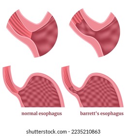 Barretts Speiseröhre. Abbildung des Magens mit Krankheit. Medizinisches Poster. Vektorgrafik