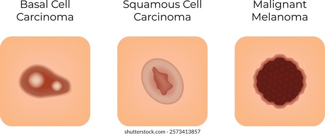 Basal Cell Squamous Cell Malignant Science Design Vector Illustration Diagram