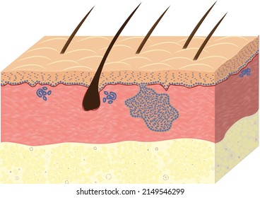 Basalioma, Skin Cancer, Histology, Vector