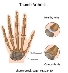 Base of thumb arthritis