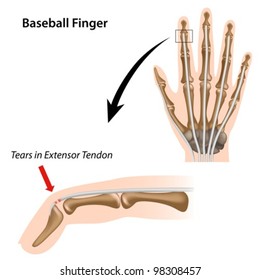 Baseball finger sport injury