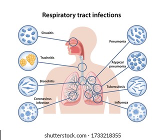 Infecciones del tracto respiratorio básico: sinusitis, traqueitis, bronquitis, neumonía, neumonía atípica, tuberculosis, gripe, coronavirus. Bacterias en vidrio de aumento. Ilustración del vector Estilo plano