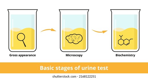 Etapas básicas de la prueba de orina. La orinálisis puede incluir un examen visual (apariencia bruta) y un examen microscópico y químico (microscopía) para buscar bacterias, células sanguíneas, proteína, glucosa