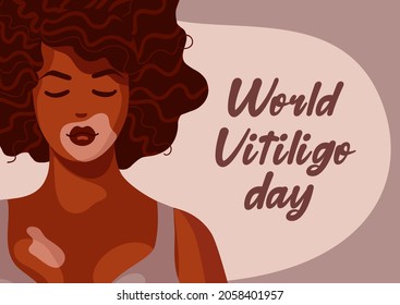 Beautiful African American woman, vitiligo on dark skin and wavy curly hair. Body positive concept vector illustration. World vitiligo day. Skin depigmentation disease. For posters, postcards, banners