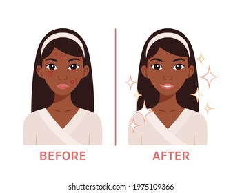 Beautiful Black Woman with Acne. Ugly.  Afro Lady with Problem Skin and Clean Face. A Teenage Girl with a Red Rash Before and After. Flat Cartoon Color Style. White background. Vector illustration.