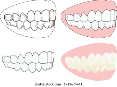 Beautiful dentition with a transparent mouthpiece. Sideways face
