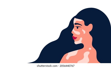 Beautiful female with vitiligo pigment skin and has a lot of blue hair vector illustration