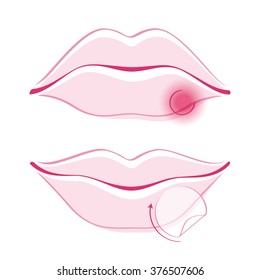 Beautiful Girl's Lips With Cold Sore Bandage Simple Style Outline Vector Illustration. Woman Face Part Icon. Good For Make-up Cosmetic Health Care Related Design.