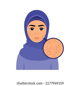 Hermosa mujer musulmana con piel seca en la cara. Problema de la piel. Vista de cierre. Bonita dama con hijab y grietas faciales. Estilo de dibujos animados de color. Fondo blanco. Ilustración vectorial para diseño de belleza médica.