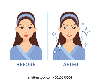 Beautiful Pretty Woman with Wrinkles on her Face. Treatment of wrinkles.
Face without Skin Problems. Clean Face and a Smile. Before and after. Color flat cartoon style. White background. Vector