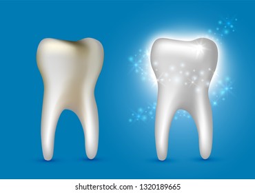 Beautiful realistic dentist vector set of decayed and white shiny cleansed tooth on blue background.