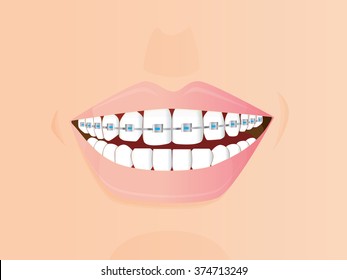 Beautiful smile with braces