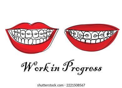 Beautiful smile. Braces and Retainers concept. Poster art. Pop art. Cool and spooky print. Teeth and wide smile. Lively bright and colorful. Glossy lips clip art. Paper cut art. Glamorous. abstract.