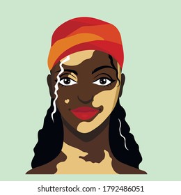 A beautiful smiling african woman with vitiligo. Self care and self love. Skin problem. Body positive, depifmentation disease. The girl accepts herself. 