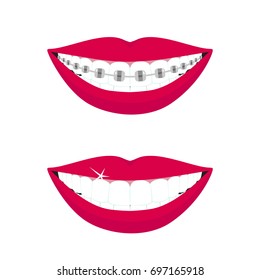 Beautiful smiling mouth with braces on teeth before and after. Design concept. Vector illustration