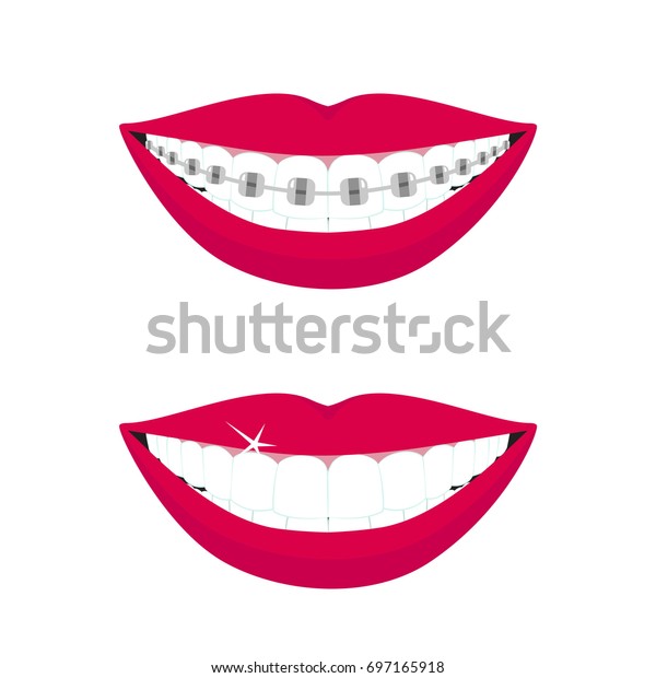 歯の前と後に中括弧が付いた美しい微笑の口 デザインコンセプト ベクターイラスト のベクター画像素材 ロイヤリティフリー