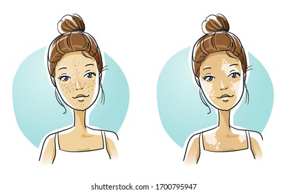 Beautiful smiling young woman with two different skin conditions: freckles and pigmentation disorder. Hand drawn cartoon sketch vector illustration, flat  coloring. 