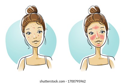 Beautiful smiling young woman with two different skin conditions: acne and rosacea. Hand drawn cartoon sketch vector illustration, flat  coloring. 