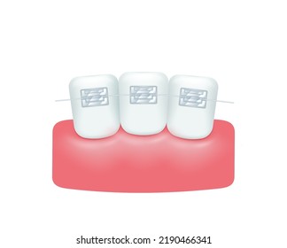 Hermosos dientes rectos después de cepas. Elementos de estilo de tratamiento ortodoncista. Dientes blancos con corchetes metálicos aislados sobre fondo blanco. Salud de la atención odontológica. Ilustración vectorial 3d realista