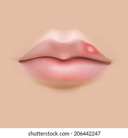 Beautiful vector realistic lips with an ugly colds herpes