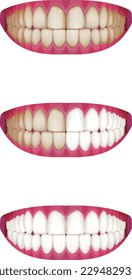 Bellos dientes blancos y dientes manchados Plaque