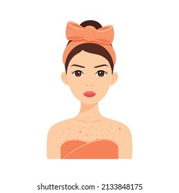 Beautiful Woman with Acne on Chest and Neck. Skin Problems on Breast. Inflammation and Red Pimples. Portrait of Adult Young Girl. Color Cartoon style. White background. Vector image for Medical design