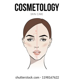 Beautiful woman face with Acne skin problems before and after vector illustration. Skin care. Cosmetology. Perfect skin. Beautiful portrait young girl, Sketch. Vector illustration. Spa beauty concept