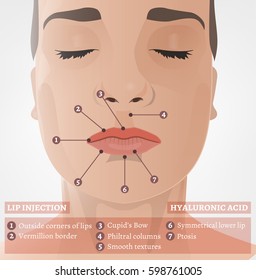 Beautiful woman face during the cosmetological procedure. Hyaluronic acid lip injections scheme. Vector illustration in light beige colours.