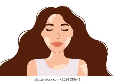 Mujer hermosa con la piel del vitiligo. Positividad corporal y autoaceptación. Condición de la piel, Ilustración vectorial