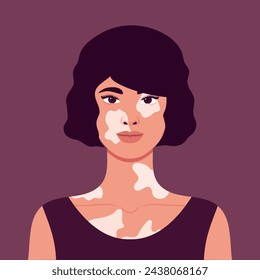 Beautiful young woman with vitiligo depigmentation. Rare appearance. Portrait or an avatar. Vector illustration