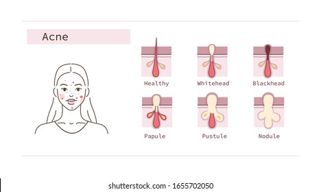 Beauty Girl Have Acne Skin Problems. Skin Layers with different Acne Types. Open and Closed Facial Comedones, Papule, Pustule. Epidermis Tissue Inflammation. Flat Vector Illustration and Icons set.