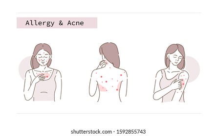 Beauty Girl Have Allergy And Acne Skin Problems. Woman Scratching Her Body And Face With Hand. Allergic Dermatitis, Eczema Or Nettle Rash With Itch Symptoms.  Flat Line Cartoon Vector Illustration.