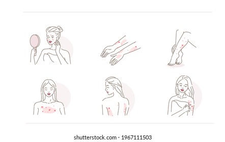 Beauty Girl Have Allergy and Acne Skin Problems. Woman Scratching her Body and Face with Hand. Allergic Dermatitis, Eczema or Nettle Rash with Itch Symptoms. Flat Line Cartoon Vector Illustration.