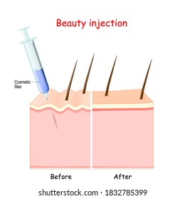 Beauty injection. syringe with Cosmetic filler. aging of the skin. Before injection (skin with wrinkles), and younger skin after cosmetology procedure. Vector illustration.