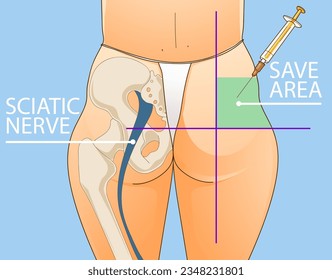 Beauty injections. Non-surgical correction. Save area. Sciatic nerve. Healthcare illustration. Beauty illustration. Vector illustration. 