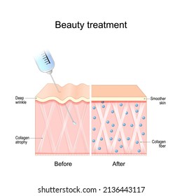 Beauty treatment. Human skin before and after procedure. Collagen atrophy and Deep wrinkle. Smoother skin after injection. Vector illustration