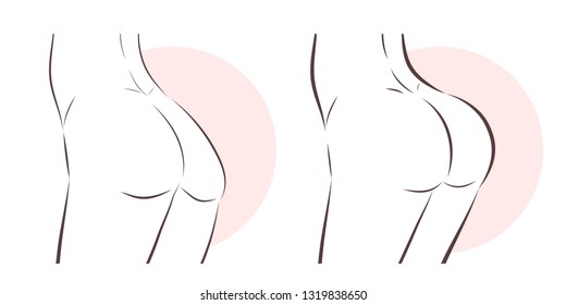 Beauty Woman With Butt Implant Before And After