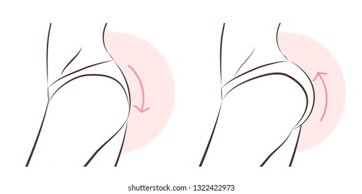 beauty woman with butt implant before and after