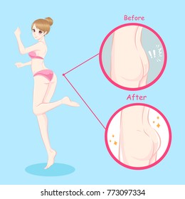 beauty woman with butt implant before and after