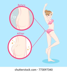 beauty woman with butt implant before and after