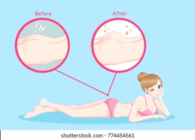 beauty woman with butt implant before and after
